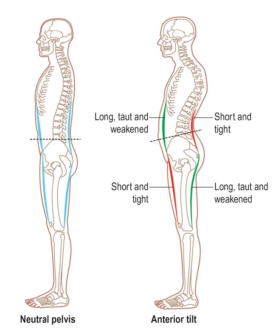 Pelvic alignment and your posture - Westcoast SCI